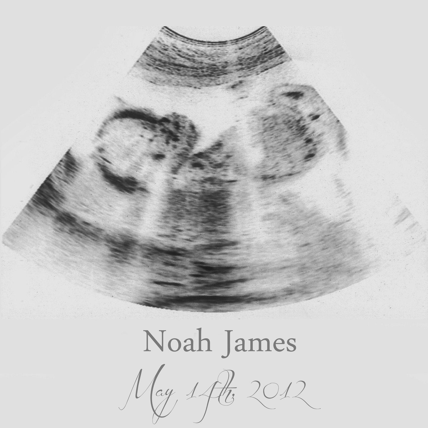 Custom Ultrasound Canvas
